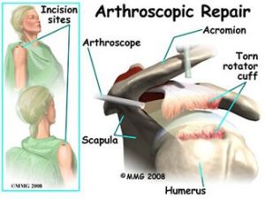 Arthroscopic Surgery2