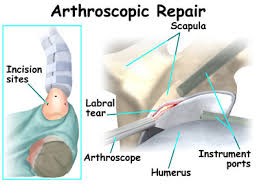 Arthroscopic Surgery3