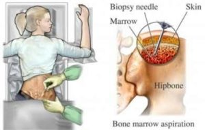 Bone Marrow Transplant3