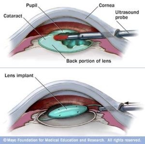 Cataract Surgery2