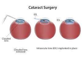 Cataract Surgery3