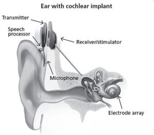 Cochlear Plant