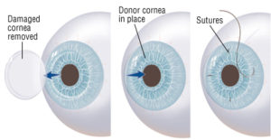 cornea-transplant