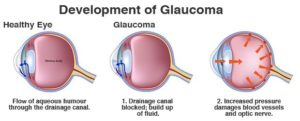 Glaucoma 3