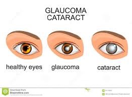 Glaucoma 4