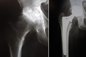 Joint Replacement