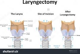 Laryngectomy3