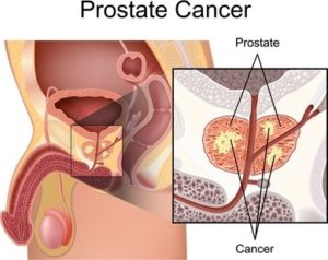 Prostate Cancer2