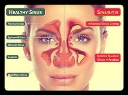 Sinus2