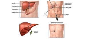 laparoscopic cholecystectomy3